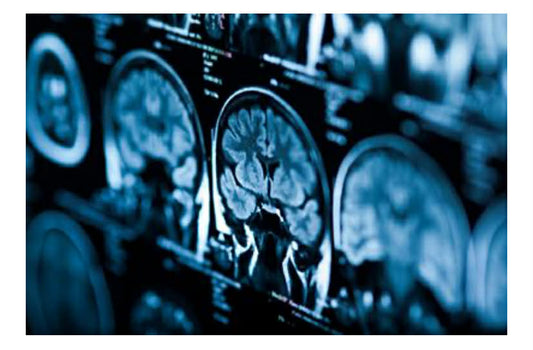 What is Type 3 Diabetes?